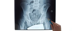 statin treatment and abnormal LFTs - General