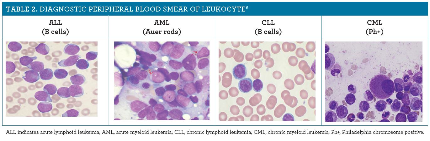 Leukemia: Causes, Symptoms, and Treatments