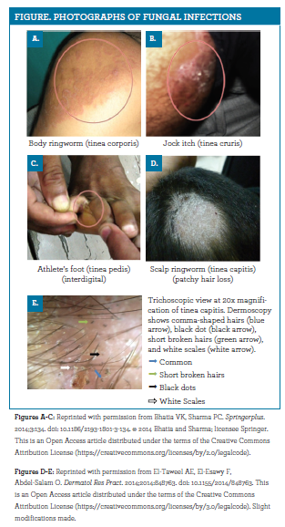 Identifying And Managing Fungal Skin Infections